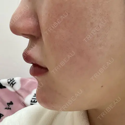 ヒアルロン酸注入（あご） / ヒアルロン酸注入（唇） PRO CLINIC プロクリニック 銀座院 DAY 0