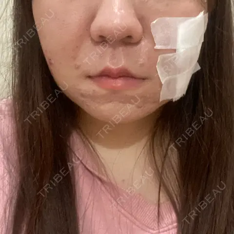 脂肪吸引（顔） / 脂肪吸引注射（顔） ziz CLINIC DAY 0