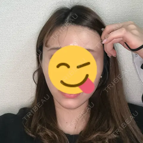 ハイフ（顔） L‘amour clinic Tokyo【ラムールクリニック東京】 AFTER