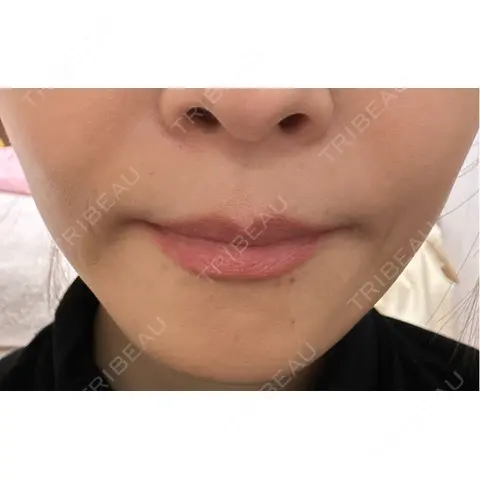 ヒアルロン酸注入（頬） 湘南美容クリニック 銀座院 AFTER