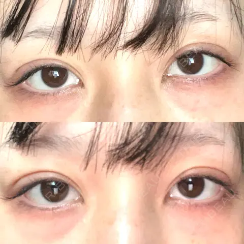 二重埋没 BELINDA CLINIC（ベリンダクリニック）新宿院 AFTER