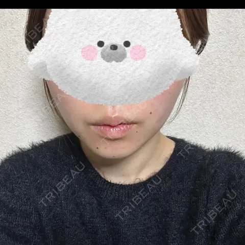 ボトックス（エラ・小顔） HELLATH CLINIC 新宿院 DAY 0