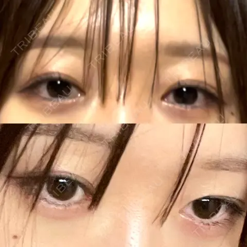 二重埋没 水の森美容クリニック 大阪院 AFTER