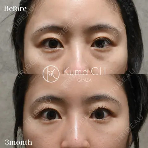 クマ治療 Kuma CLI 【クマクリ】 AFTER