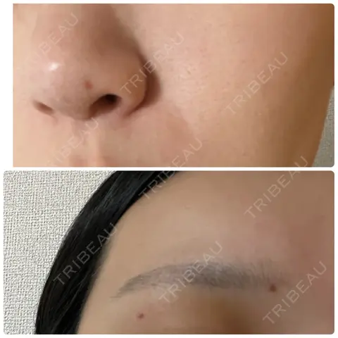 ほくろ・いぼ除去レーザー（肌） Mavie Beauty Clinic （マヴィービューティークリニック） DAY 3