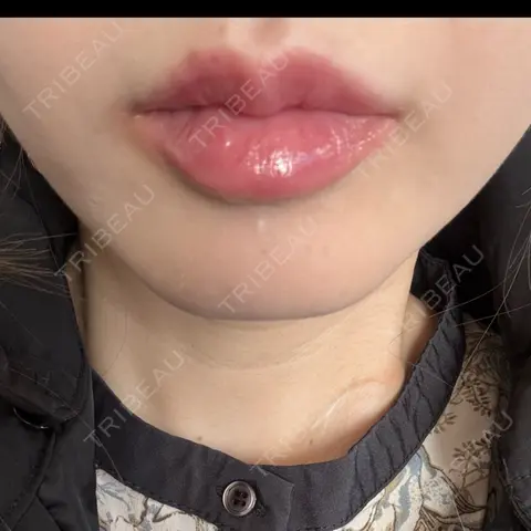 ヒアルロン酸注入（唇） L‘amour clinic Tokyo【ラムールクリニック東京】 AFTER