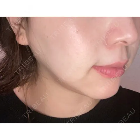 ルメッカ GLAMRULE CLINIC (グラムルール クリニック) 銀座院 DAY 2