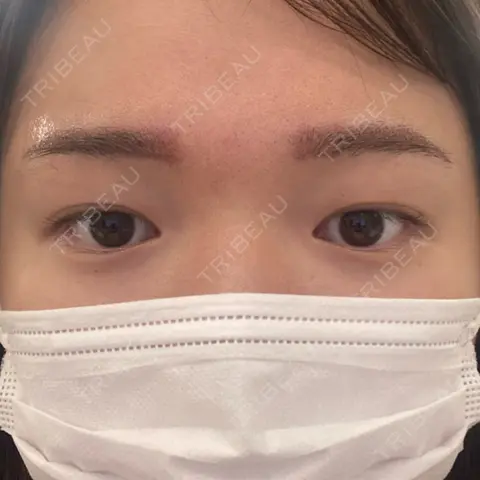 アートメイク（眉） Tokyo Tensei Clinic 新宿院 DAY 0