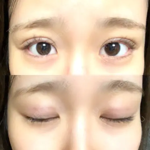二重埋没 WOM CLINIC GINZA （ワム クリニック ギンザ） DAY 0