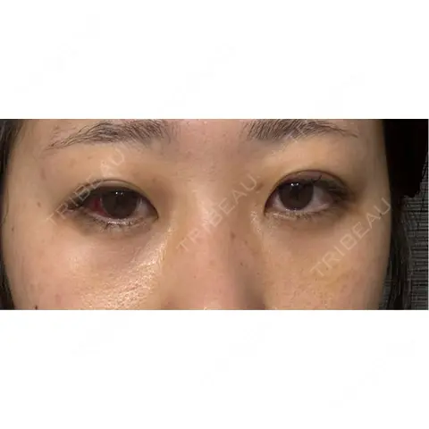 クマ治療 / 下まぶたたるみ取り / 下まぶたの脂肪取り APOLLO BEAUTY CLINIC AFTER