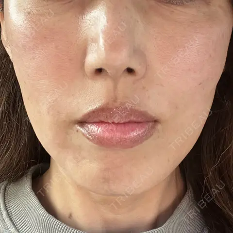 糸リフト / ヒアルロン酸注入（鼻翼基部） NARU Beauty Clinic 【ナルクリ】 DAY 0