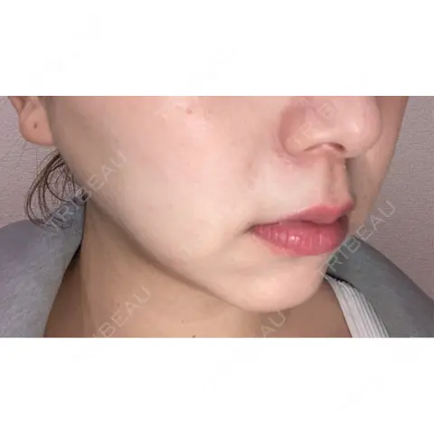 ルメッカ GLAMRULE CLINIC (グラムルール クリニック) 銀座院 AFTER