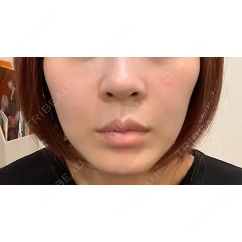 美容点滴・美容注射（美肌） / ヒアルロン酸注入（鼻翼基部） ヴェリテクリニック 大阪院 DAY 0