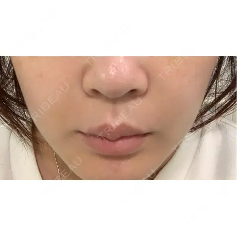 美容点滴・美容注射（美肌） / ヒアルロン酸注入（鼻翼基部） ヴェリテクリニック 大阪院 AFTER