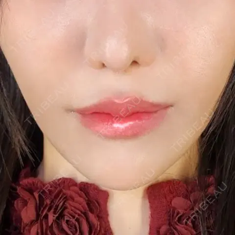 糸リフト / 人中短縮 / ボトックス（あご） / ヒアルロン酸注入（あご） / ボトックス（人中） / ヒアルロン酸注入（鼻翼基部） Tokyo Tensei Clinic 新宿院 AFTER