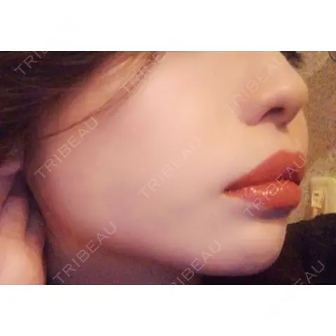 脂肪吸引（顔） / 脂肪吸引注射（顔） ziz CLINIC AFTER