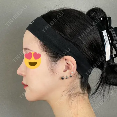 糸リフト / バッカルファット除去 / 脂肪吸引（顔） / ジョールファット除去 / ボトックス（エラ・小顔） / ヒアルロン酸注入（唇） アリエル美容クリニック 大宮院 AFTER