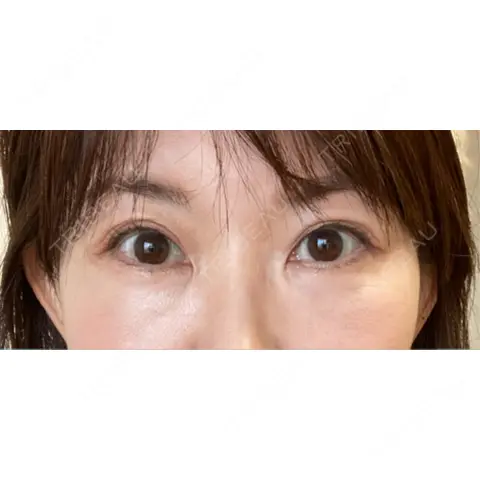 リジュラン DMTC美容皮膚科 日本橋院 AFTER