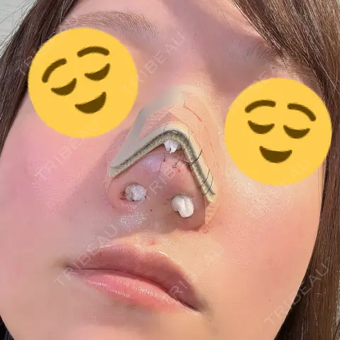 鼻尖形成（非切開） 銀座マイアミ美容外科 DAY 0