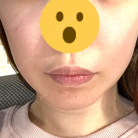ハイフ（顔） ちぐさ内科クリニック 覚王山 AFTER