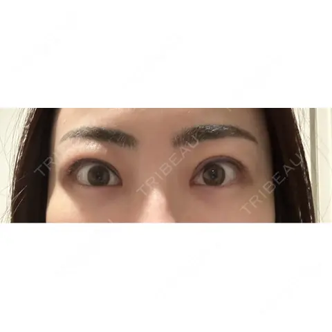二重切開 / 目頭切開 / 眼瞼下垂（切開） / 上まぶたの脂肪取り WOM CLINIC GINZA （ワム クリニック ギンザ） AFTER