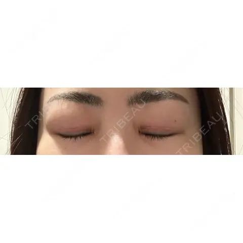 二重切開 / 目頭切開 / 眼瞼下垂（切開） / 上まぶたの脂肪取り WOM CLINIC GINZA （ワム クリニック ギンザ） AFTER