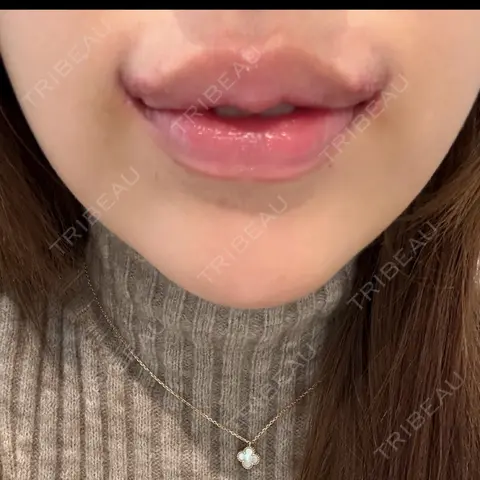 口角挙上 R Beauty CLINIC 銀座院 DAY 7
