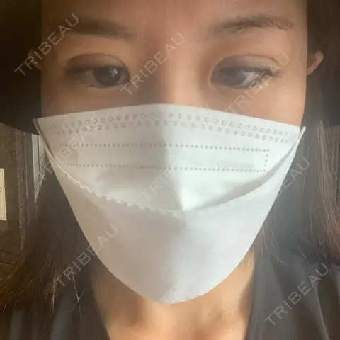 二重埋没 / 眼瞼下垂（非切開） A CLINIC（エークリニック） 銀座院 AFTER