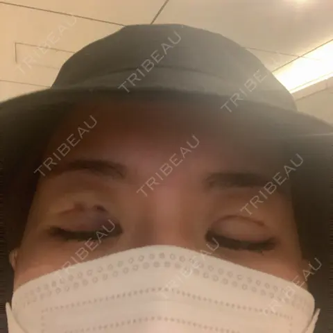 二重埋没 / 眼瞼下垂（非切開） A CLINIC（エークリニック） 銀座院 AFTER