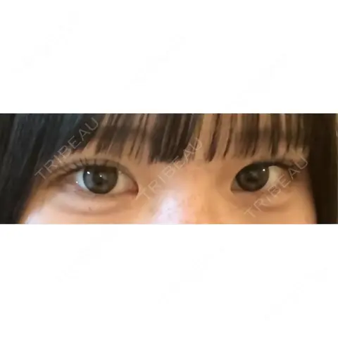 二重埋没 くさのたろうクリニック AFTER