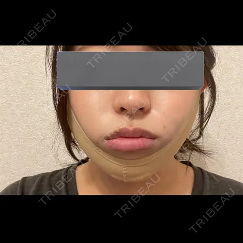 糸リフト / 脂肪吸引（顔） / 脂肪吸引注射（顔） / ヒアルロン酸注入（あご） / ボトックス（エラ・小顔） SEA CLINIC（シークリニック） DAY 0