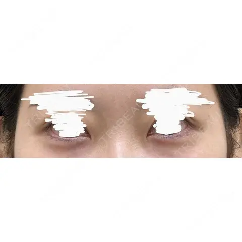 ヒアルロン酸注入（涙袋） / ヒアルロン酸注入（唇） / ボトックス（口角） / ボトックス（人中） KAGA CLINIC DAY 0