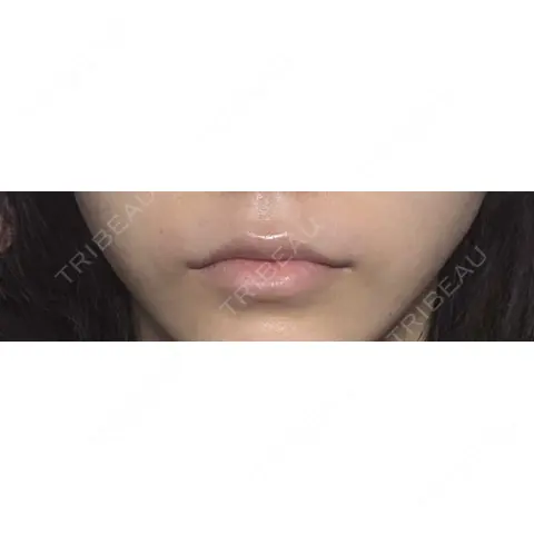 ヒアルロン酸注入（涙袋） / ヒアルロン酸注入（唇） / ボトックス（口角） / ボトックス（人中） KAGA CLINIC AFTER