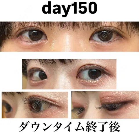 二重切開 ルネッサンス美容外科医院 青山本院 AFTER