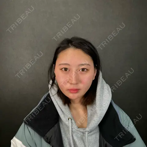 二重埋没 / 隆鼻術 / 脂肪吸引（顔） / タレ目形成・グラマラスライン（切開） / ヒアルロン酸注入（あご） ネビュラクリニック 京都院 AFTER