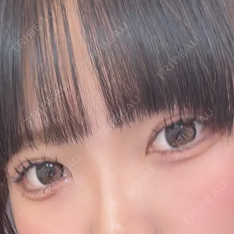 二重埋没 WOM CLINIC GINZA （ワム クリニック ギンザ） AFTER