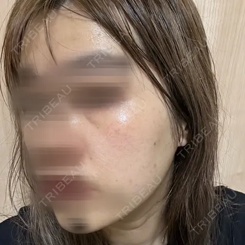 ハイフ（顔） / シミ取りレーザー / エレクトロポレーション 湘南美容クリニック 博多院 AFTER