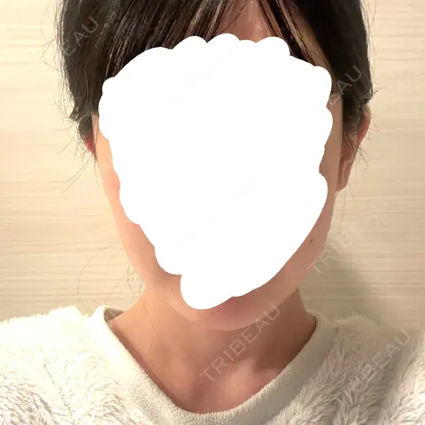 骨切り（あご） / 骨削り（エラ） / 骨削り（頬） セギム美容整形外科 AFTER