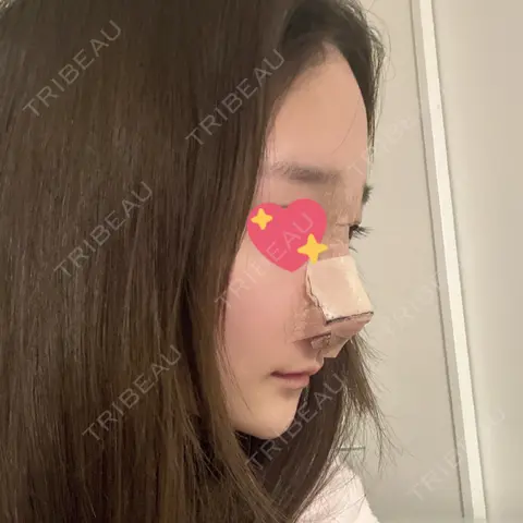 隆鼻術 / 鼻尖形成（切開） / 鼻中隔延長（切開） / 軟骨移植 X CLINIC 大阪院 DAY 0