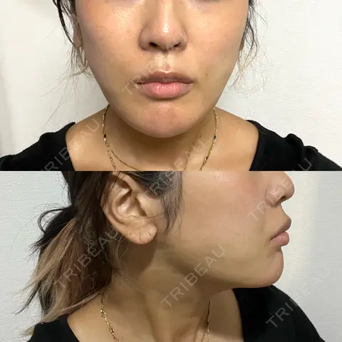 脂肪吸引（顔） Mods Clinic（モッズクリニック） 東京院 DAY 1