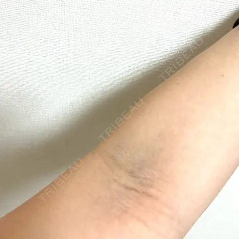 白玉点滴・注射 X CLINIC 大阪院 AFTER