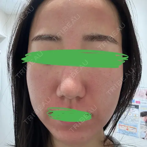 ピコレーザートーニング（美白・肝斑） / ピコフラクショナルレーザー（毛穴・ニキビ跡） おおかみ美容のクリニック 新宿院 DAY 0