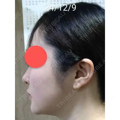 脂肪吸引（顔） Mods Clinic（モッズクリニック） 東京院 AFTER