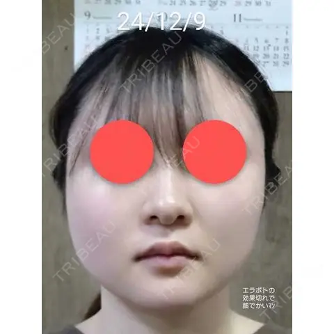 脂肪吸引（顔） Mods Clinic（モッズクリニック） 東京院 AFTER