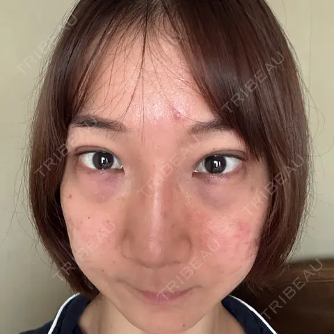 二重埋没 / クマ治療 / 下まぶたの脂肪取り / ヒアルロン酸注入（目の下） 東京シンデレラ美容外科 池袋院 DAY 0