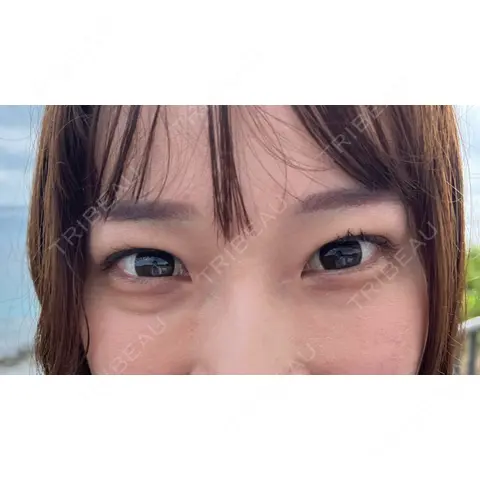二重埋没 / クマ治療 / 下まぶたの脂肪取り / ヒアルロン酸注入（目の下） 東京シンデレラ美容外科 池袋院 AFTER