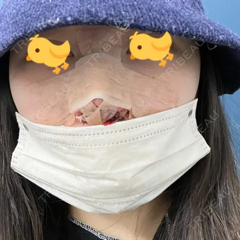 鼻尖形成（切開） / 鼻中隔延長（切開） / その他（鼻） グローバルビューティークリニック 銀座院 DAY 1