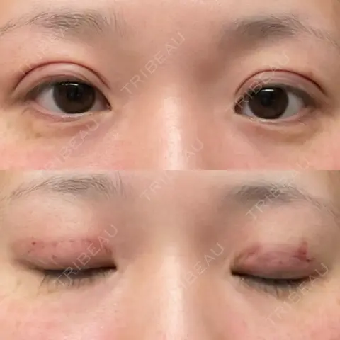 二重埋没 / 上まぶたの脂肪取り / 目元修正 藤・ナチュレ美容クリニック 銀座院 DAY 0
