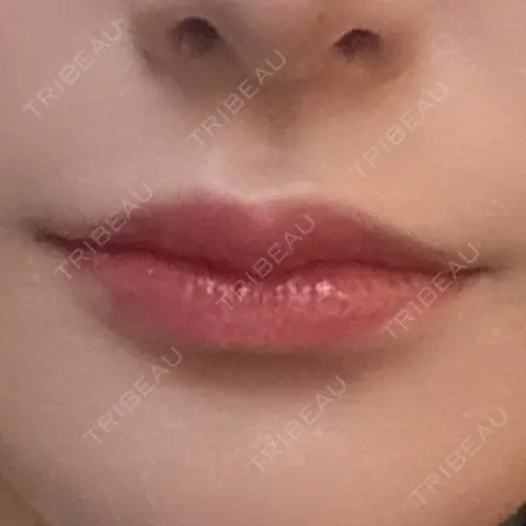 ヒアルロン酸注入（唇） R Beauty CLINIC 銀座院 AFTER