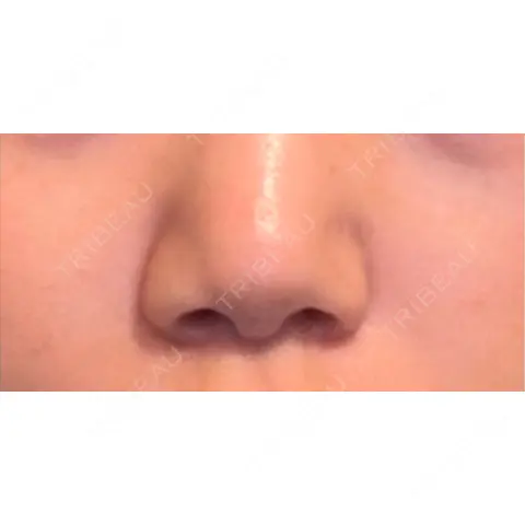 ヒアルロン酸注入（鼻翼基部） KAGA CLINIC AFTER